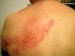 herpes-zoster-simptomi-i-lečenje